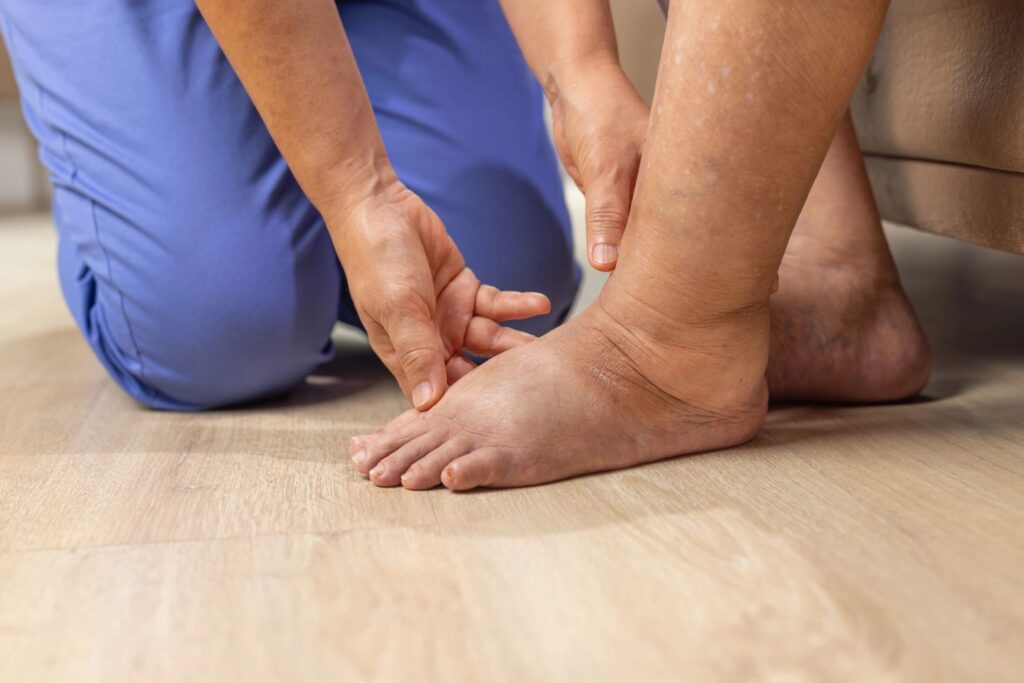Elderly woman has edema or swelling foot.
